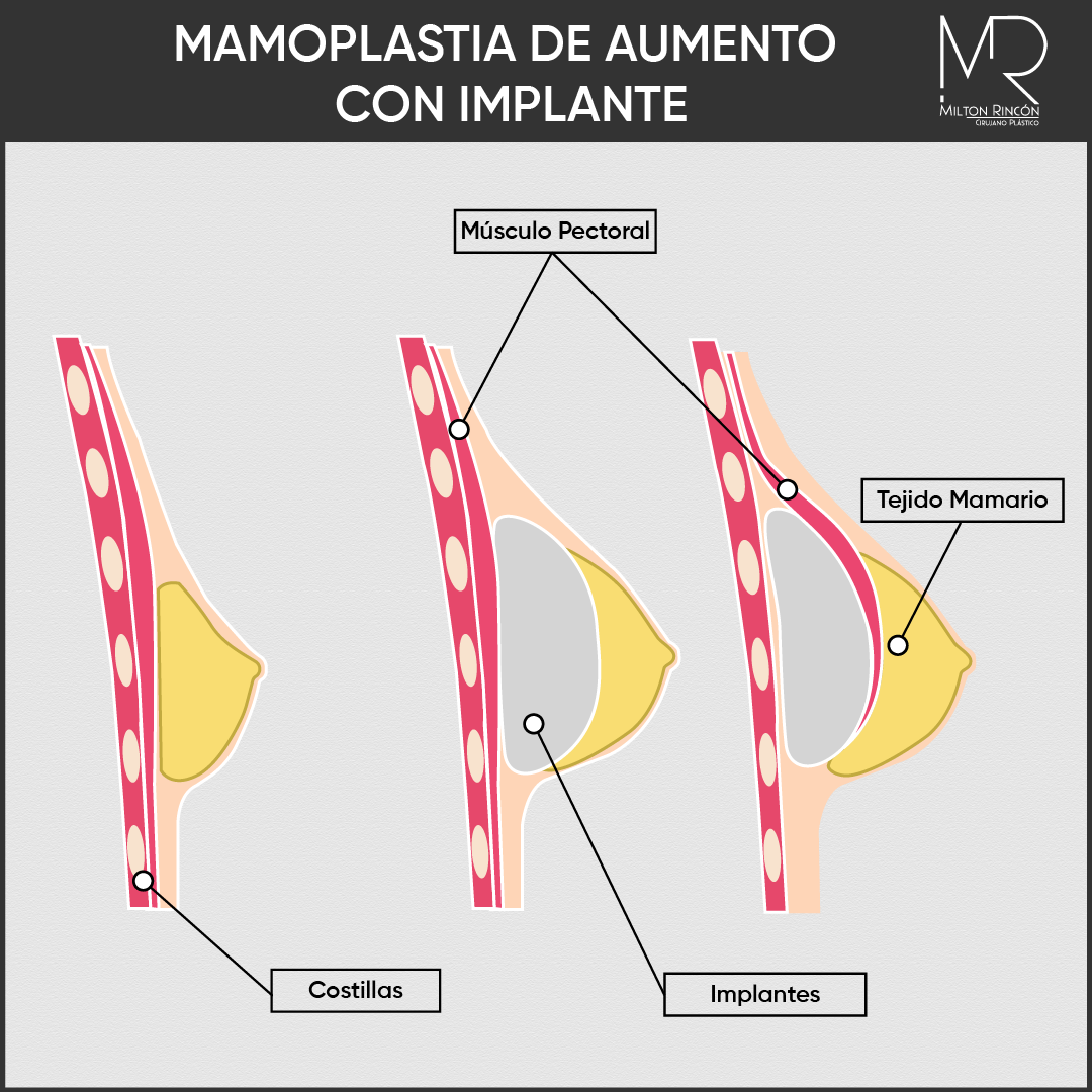 Evolución de abdominoplastia